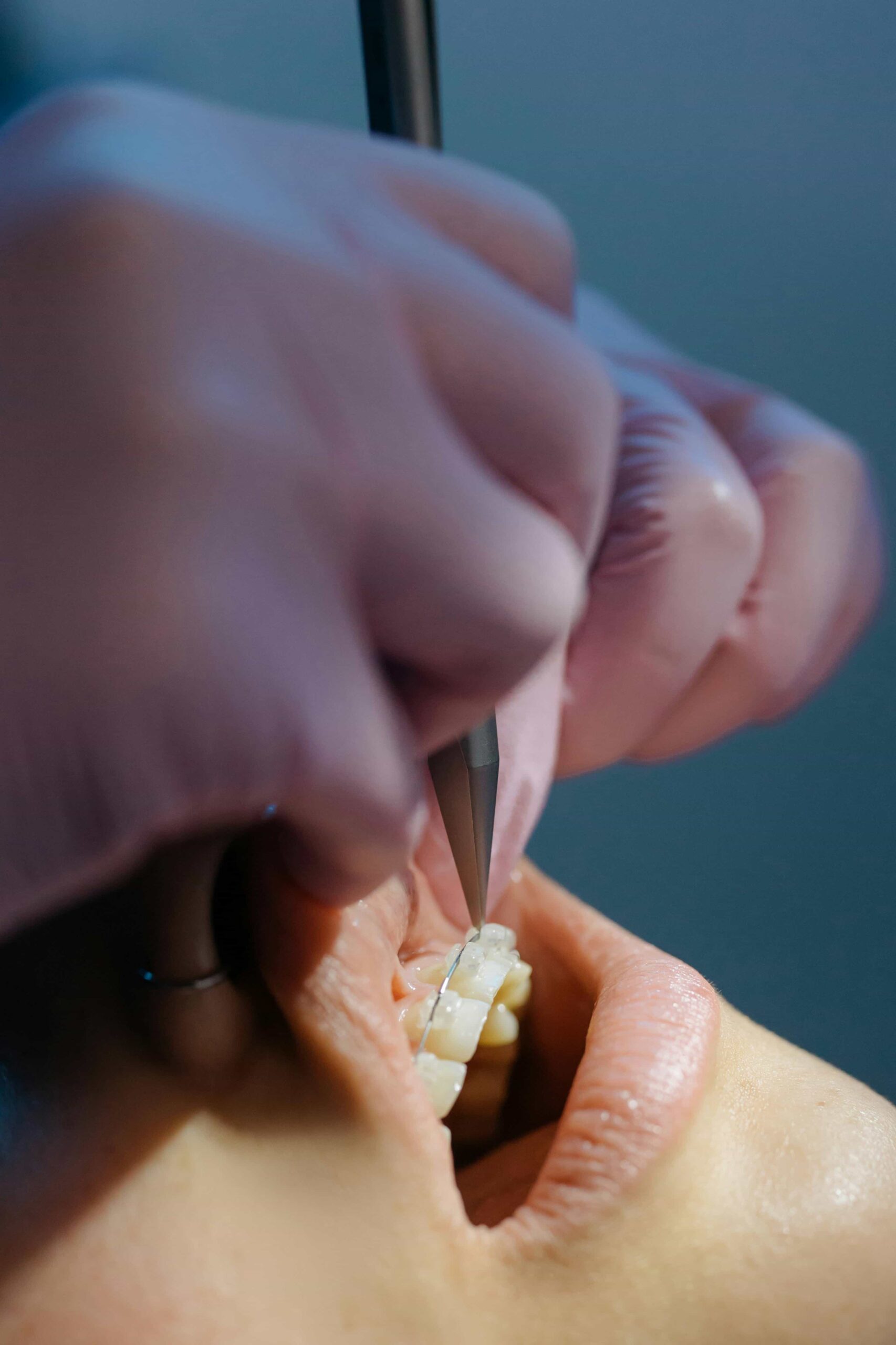 brackets on teeth