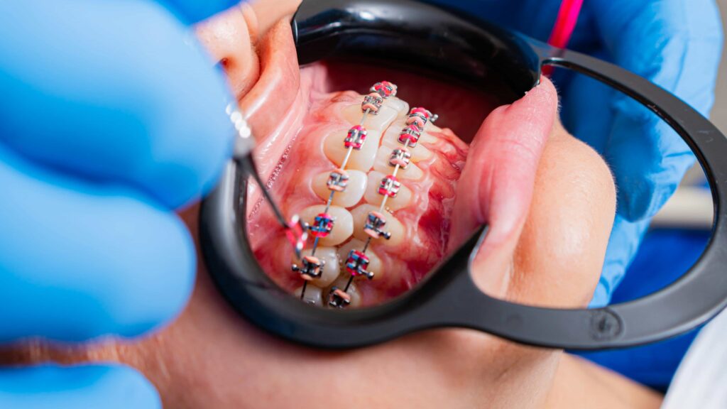 adjusting braces and brackets