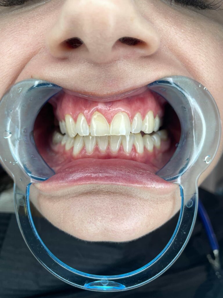 mouth holding in a persons mouth