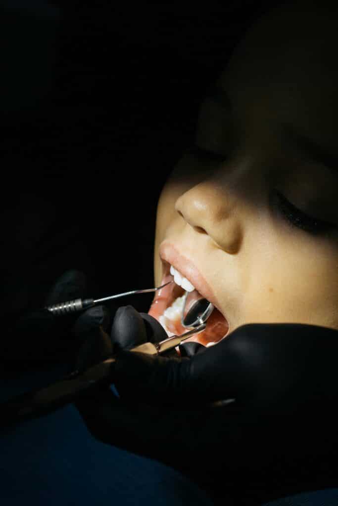 Can You Get a Palate Expander and Braces at the Same Time? 1 patient getting palate expander